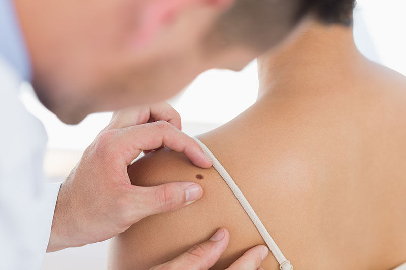 اكتشاف مفاجئ حول أخطر أشكال سرطان الجلد!