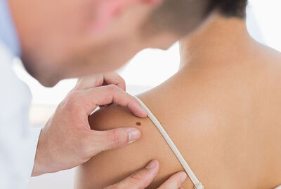 اكتشاف مفاجئ حول أخطر أشكال سرطان الجلد!