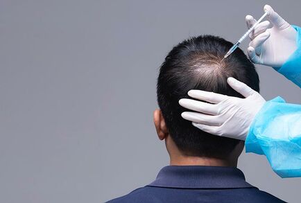 اكتشاف السبب الدقيق لتساقط الشعر ما يعد بعلاجات جديدة للصلع