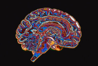 تقنية تصوير جديدة تكشف منطقة الدماغ الأكثر تضررا من 