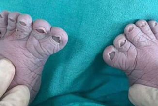 سيدة روسية تثير دهشة الأطباء بعدما أنجبت للمرة الثالثة طفلا بـ12 إصبعا في قدميه