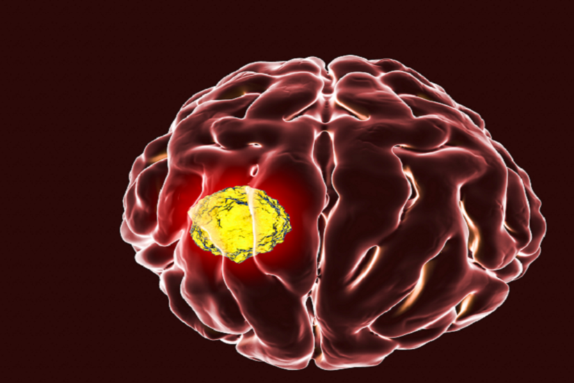 ابتكار علاج جديد لمحاربة أخطر أنواع سرطان الدماغ