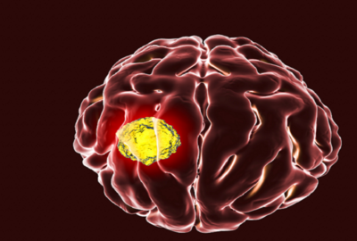ابتكار علاج جديد لمحاربة أخطر أنواع سرطان الدماغ