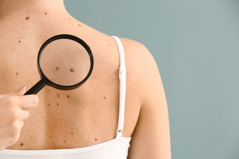 ما هي العلامات المبكرة لسرطان الجلد وكيف تبدو؟