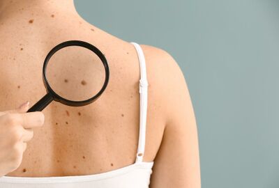 ما هي العلامات المبكرة لسرطان الجلد وكيف تبدو؟