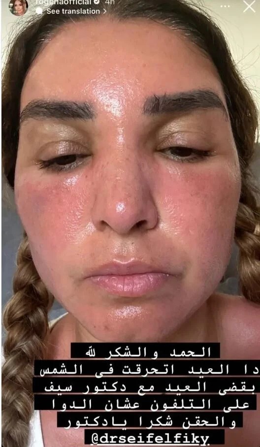 مصر.. فنانة شهيرة تكشف عن إصابتها بحروق في وجهها وتوجه رسالة لمتابعيها (صور)