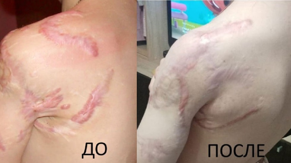 روسيا..الأطباء ينقذون يد طفلة تعرضت لهجوم أسد ويستعيدون وظائفها