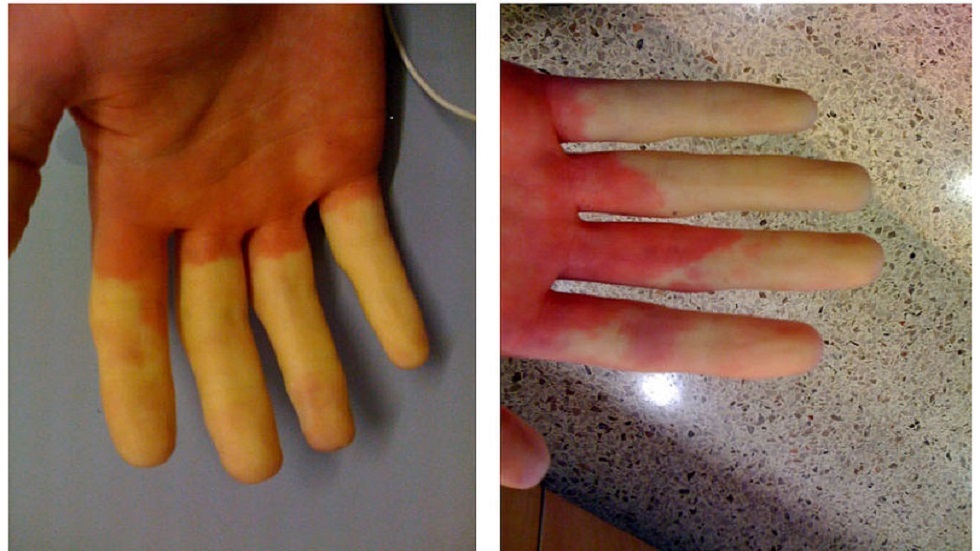 طبيب روسي يوضح ما هي الأمراض التي تشير إليها الأيادي الباردة