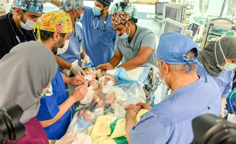 السعودية.. نجاح فصل توأم سيامي عراقي بعمل جراحي (صور)